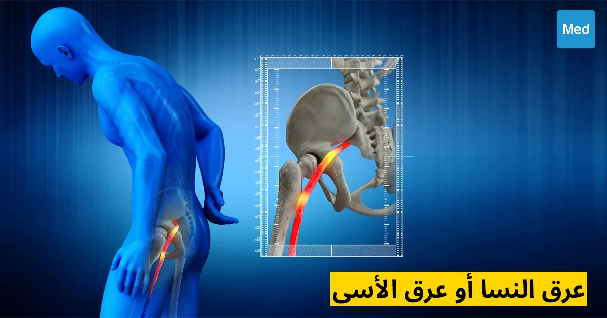 عرق النسا أو عرق الأسى